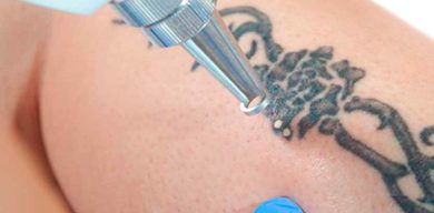 Как‌ ‌удалить‌ ‌татуировку‌