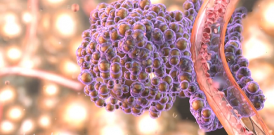 Які фактори можуть провокувати рак та як уникнути захворювання: поради сумського онколога (відео)